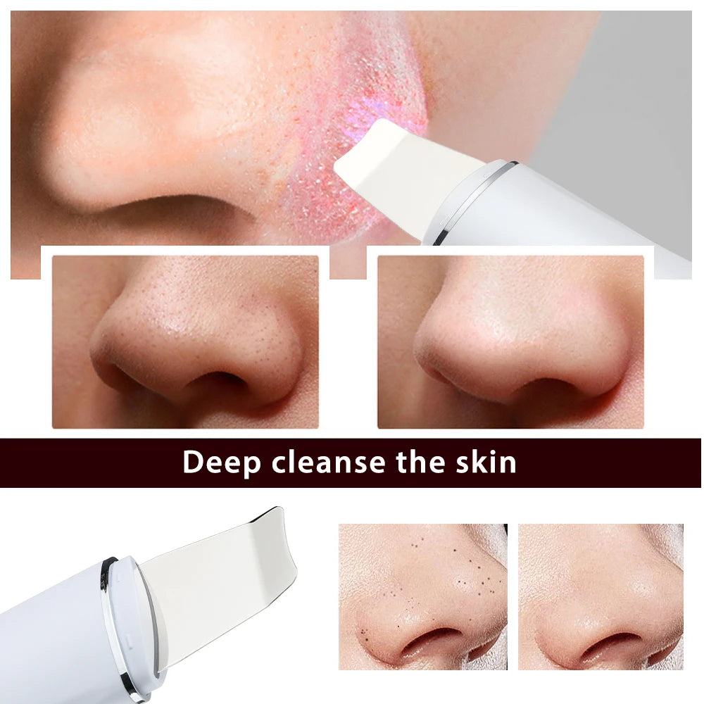 Ultrasonic Skin Scrubber Peeling Blackhead Remover Mia Vita